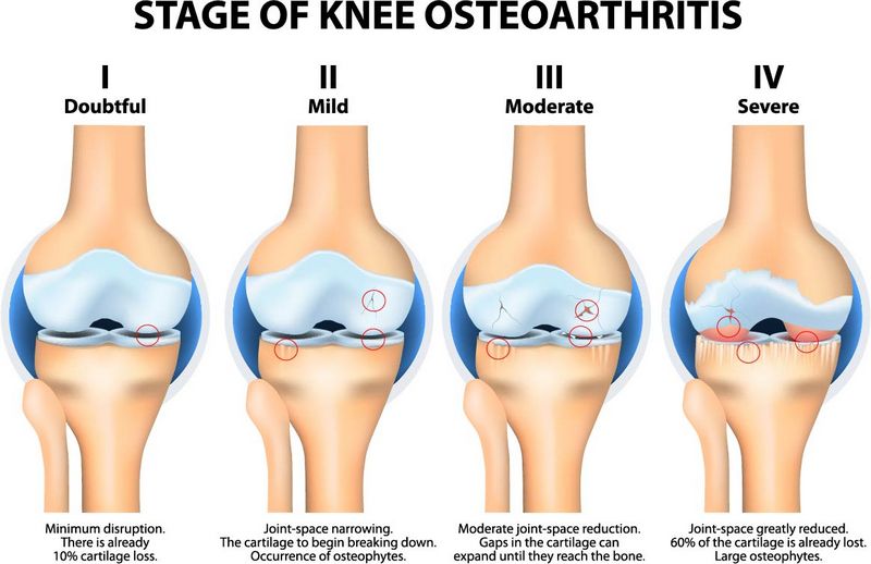 osteoarthritis knee swelling