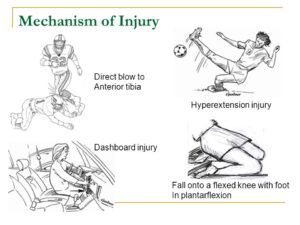 Posterior Cruciate Ligament [PCL] Tear - Sun Orthopaedic