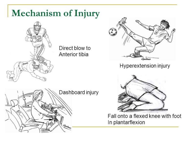 posterior-cruciate-ligament-pcl-tear-sun-orthopaedic