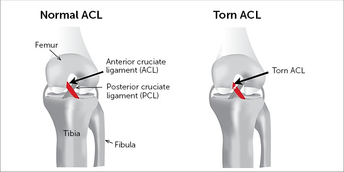 Anterior Cruciate Ligament [ACL] Tear - Sun Orthopaedic