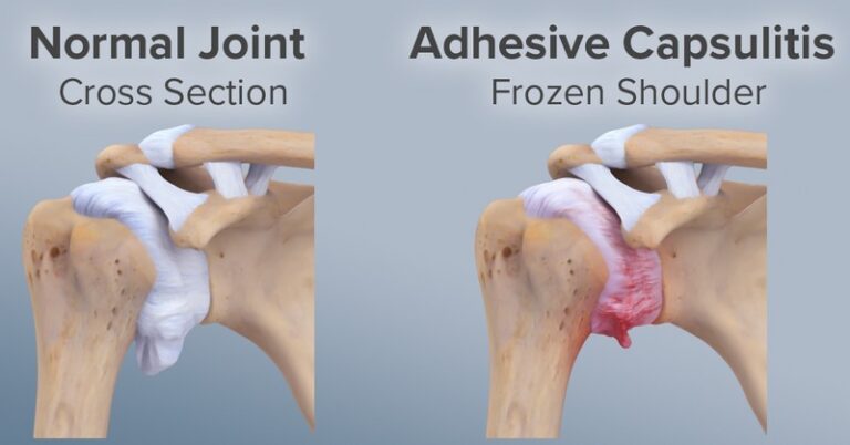 Frozen Shoulder - Sun Orthopaedic