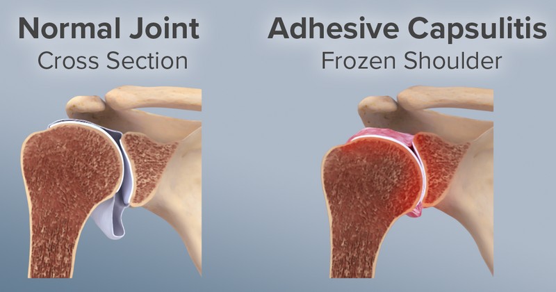 adhesive capsulitis signs and symptoms