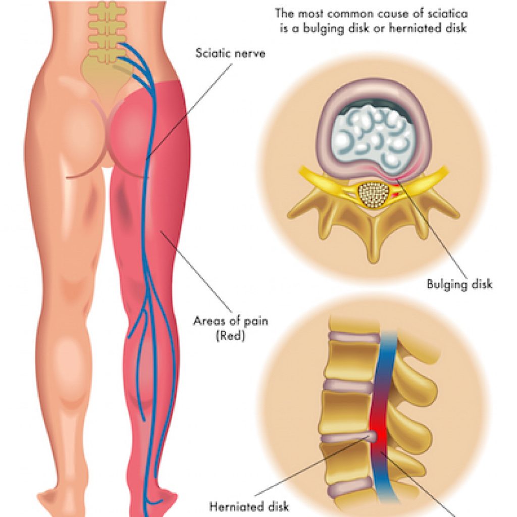 lumbar spondylosis thesis