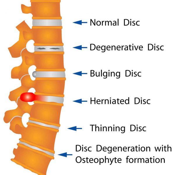 LUMBAR DISC